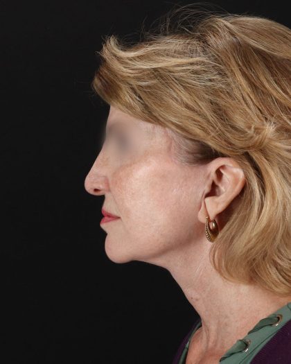 Facelift Before & After Patient #9140