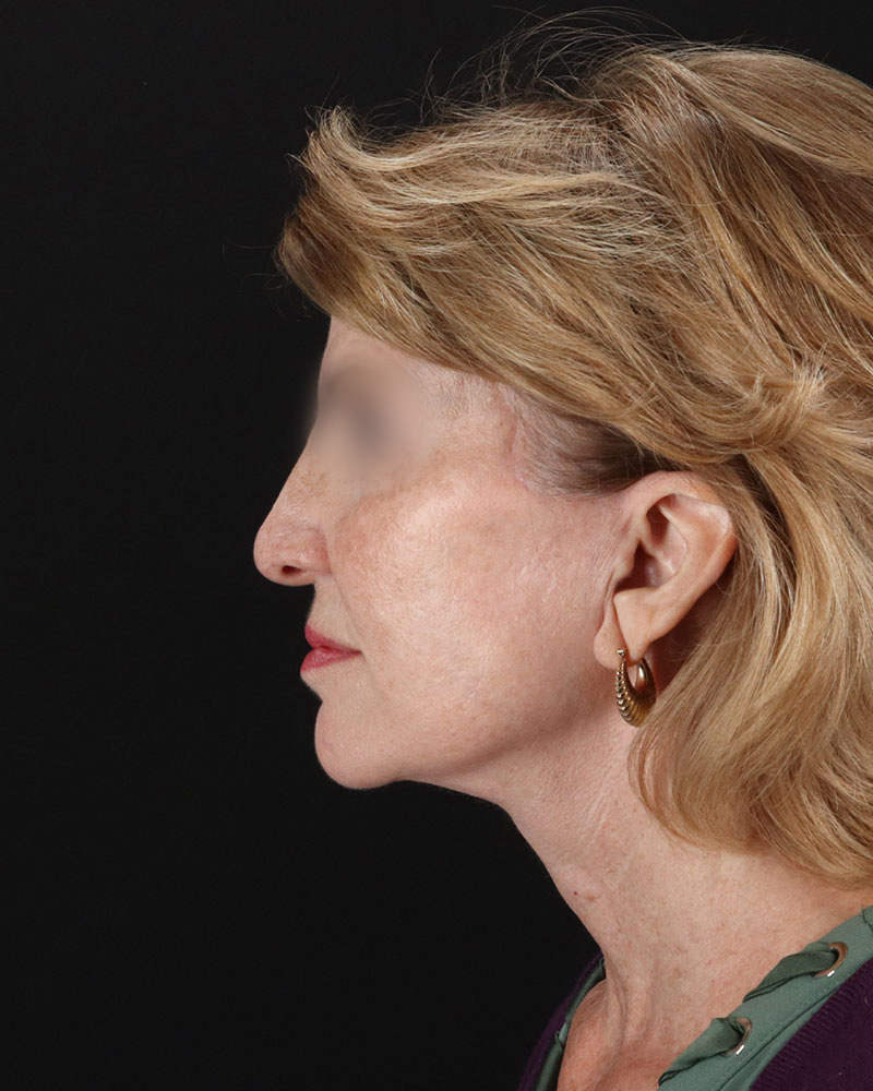 Facelift Before & After Patient #9140