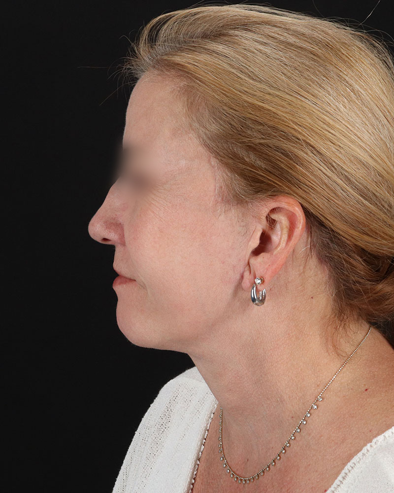 Facelift Before & After Patient #8957