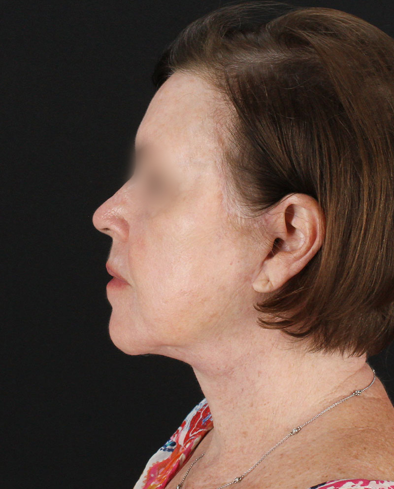 Facelift Before & After Patient #8954