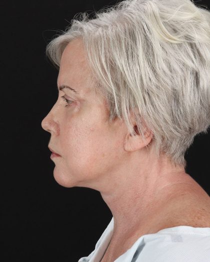 Facelift Before & After Patient #8946
