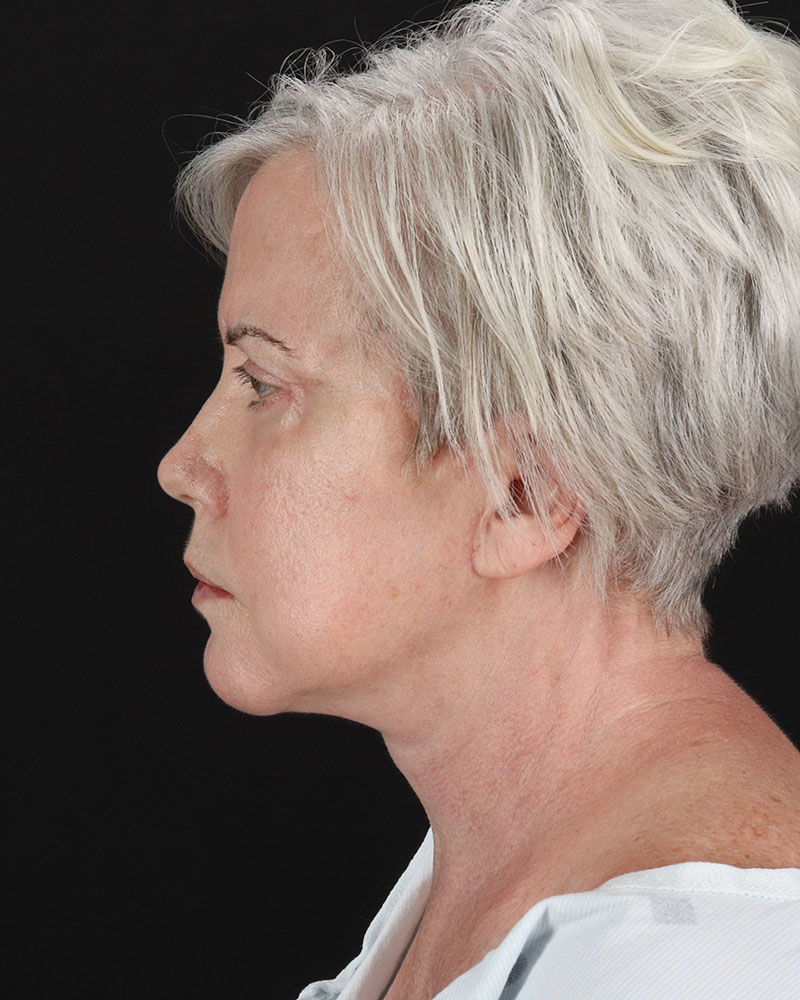 Facelift Before & After Patient #8946
