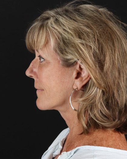 Facelift Before & After Patient #8948