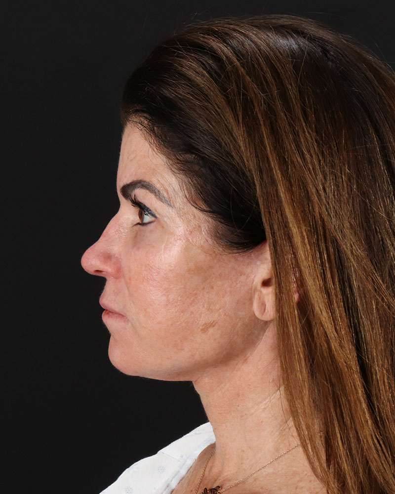 Facelift Before & After Patient #8949