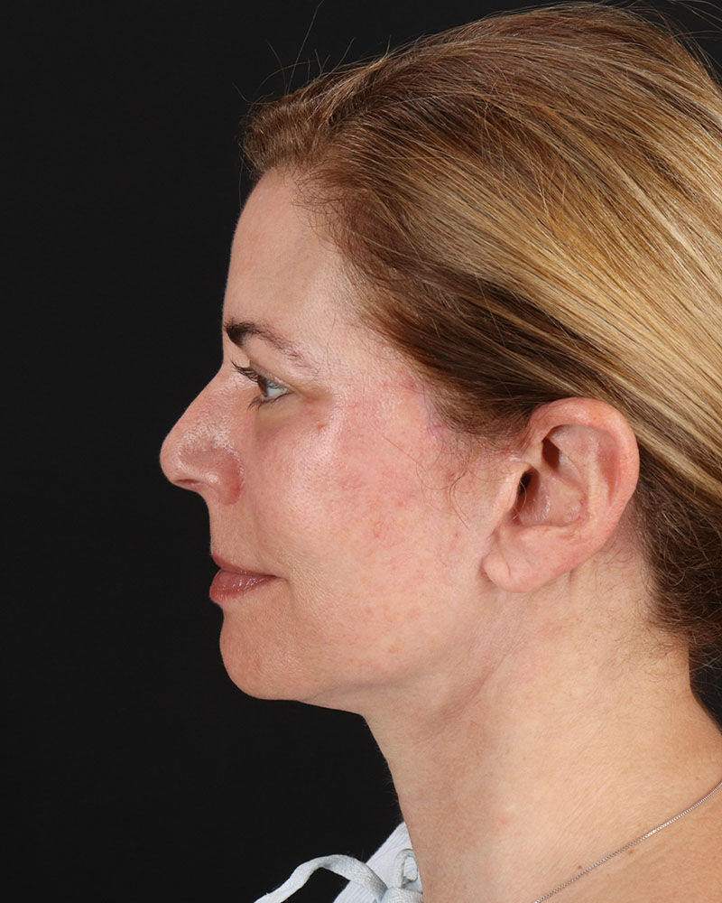Lower Blepharoplasty Before & After Patient #8951