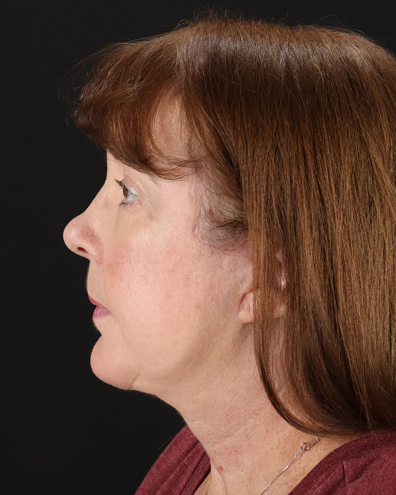 Facelift Before & After Patient #8953