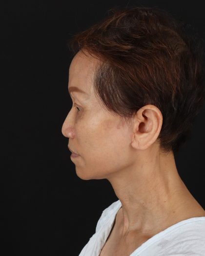 Facelift Before & After Patient #8950
