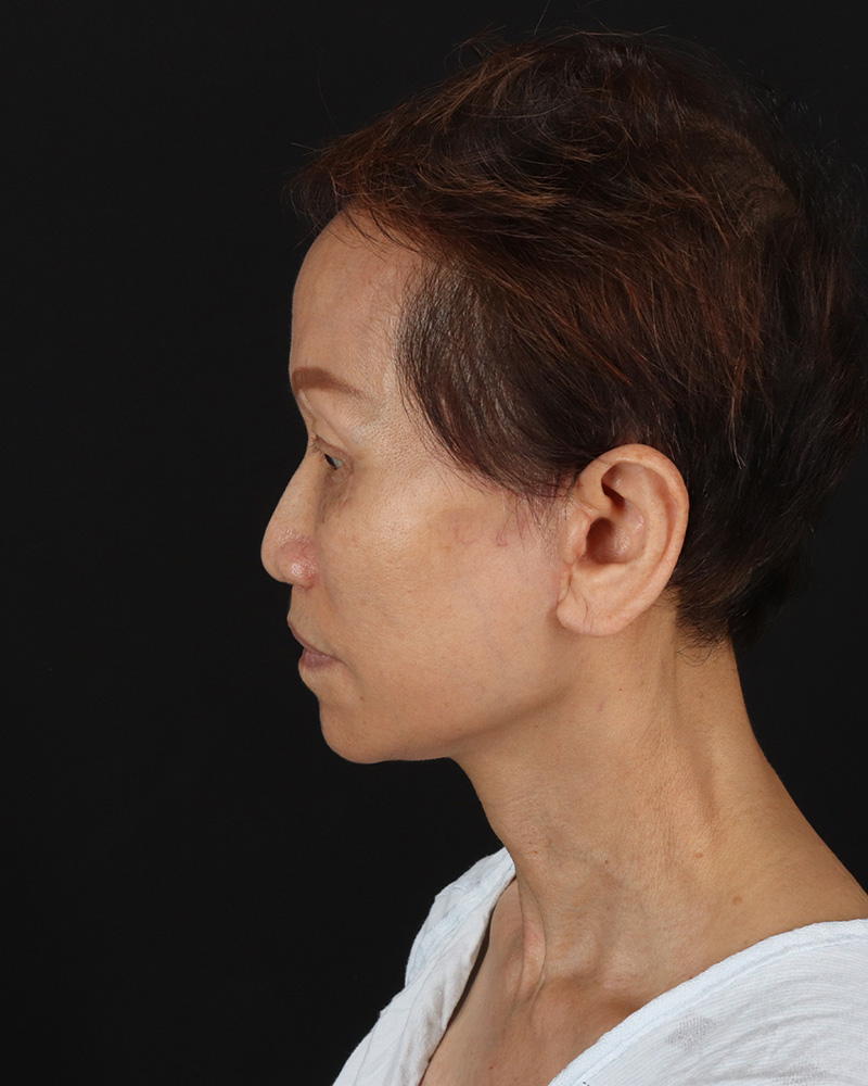 Facelift Before & After Patient #8950