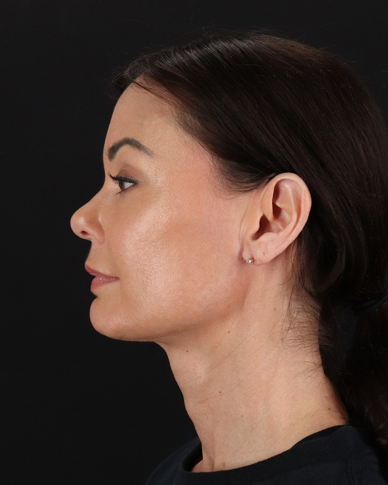 Facelift Before & After Patient #8942