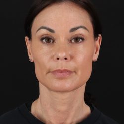 Facelift Before & After Patient #8942