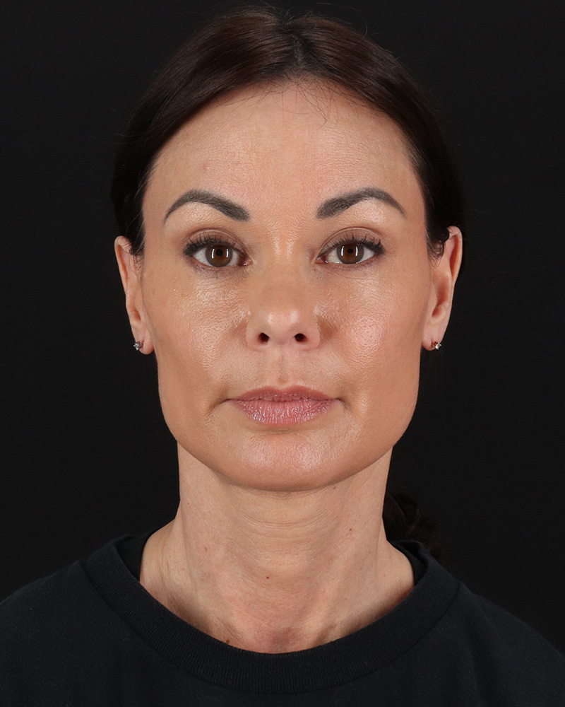 Facelift Before & After Patient #8942