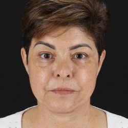 Facelift Before & After Patient #8952