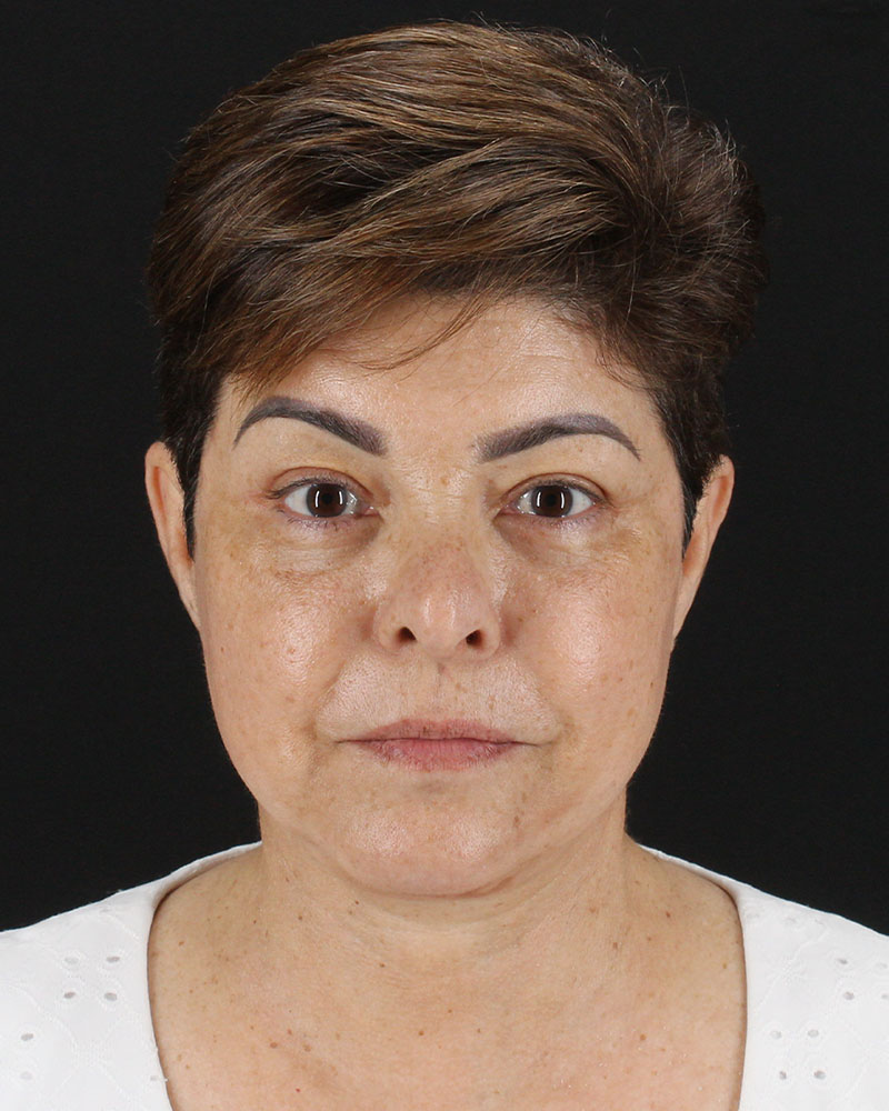 Facelift Before & After Patient #8952