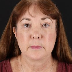 Facelift Before & After Patient #8953
