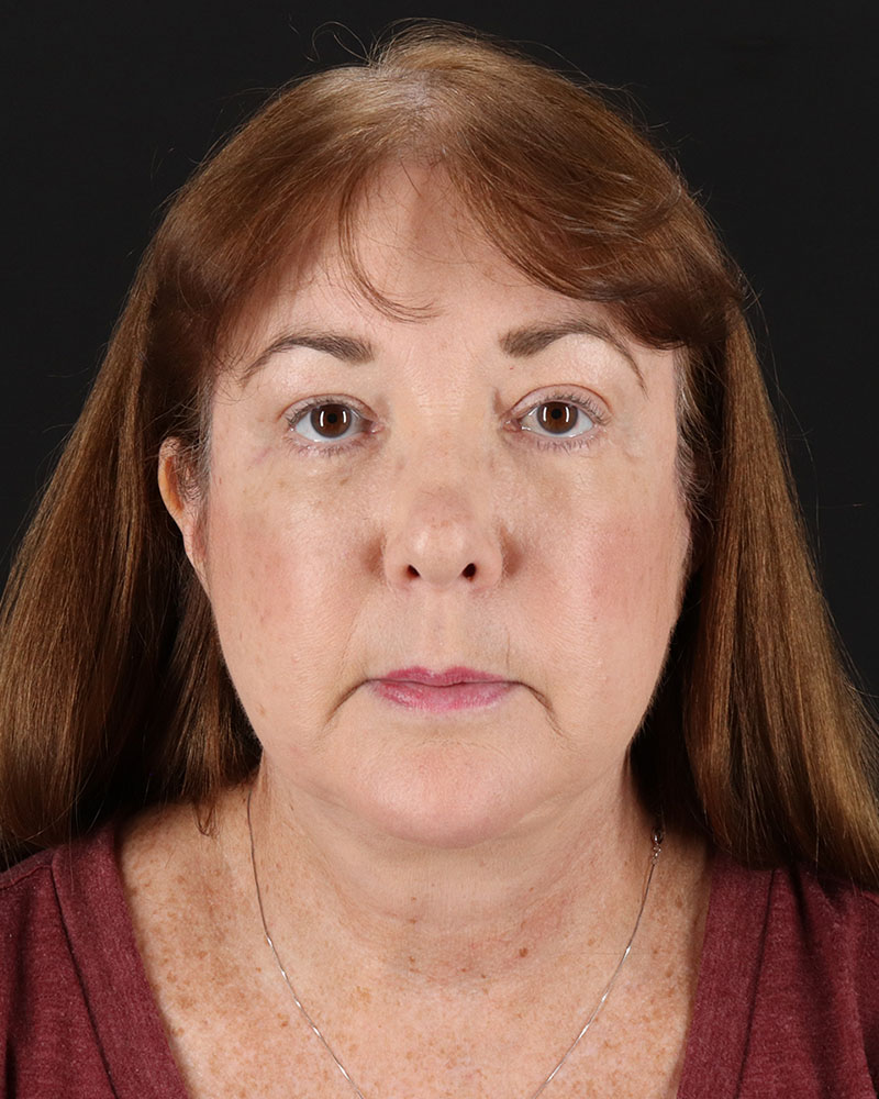 Facelift Before & After Patient #8953