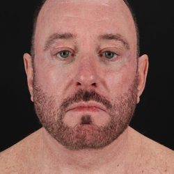 Facelift Before & After Patient #8955
