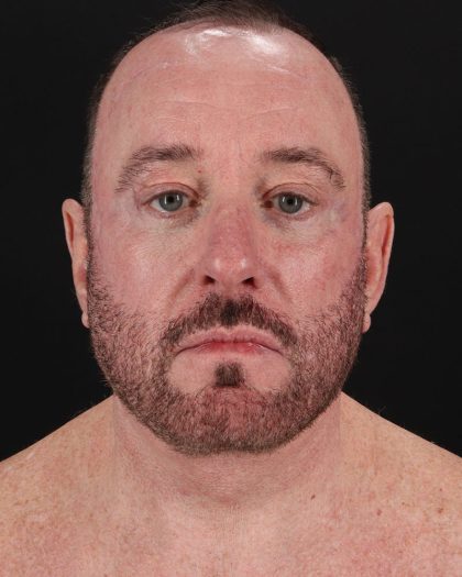 Facelift Before & After Patient #8955