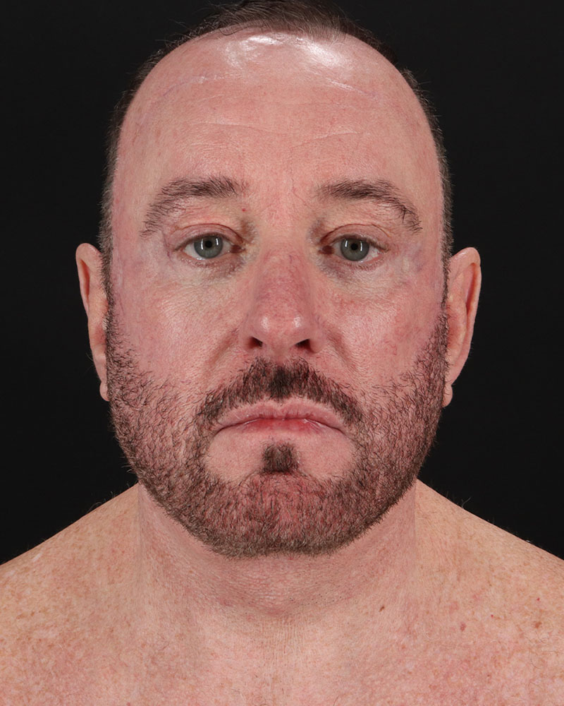 Facelift Before & After Patient #8955