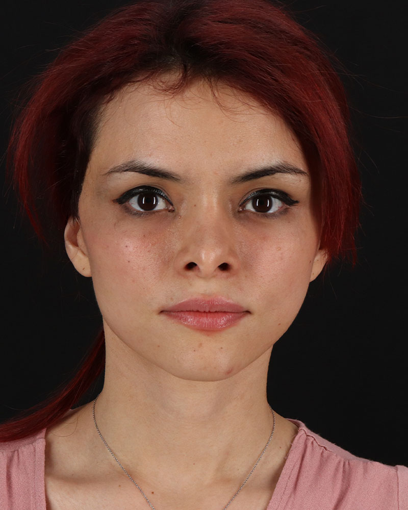 Mini Facelift Before & After Patient #8956