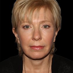 Facelift Before & After Patient #8958