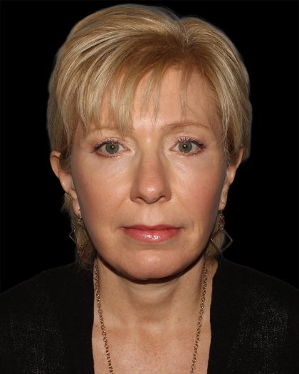 Facelift Before & After Patient #8958