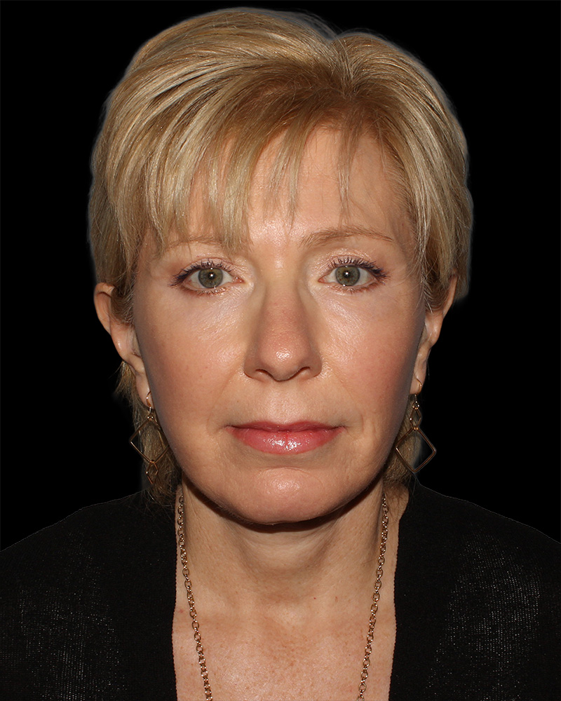 Facelift Before & After Patient #8958