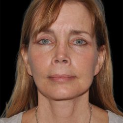 Facelift Before & After Patient #8959