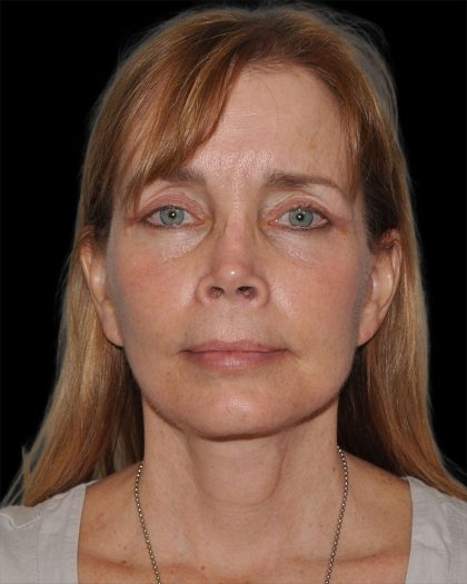 Facelift Before & After Patient #8959