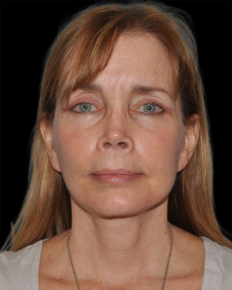 Facelift Before & After Patient #8959