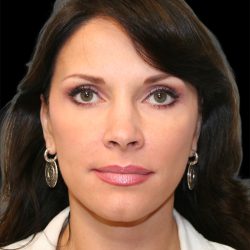 Facelift Before & After Patient #8960