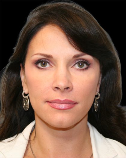 Facelift Before & After Patient #8960