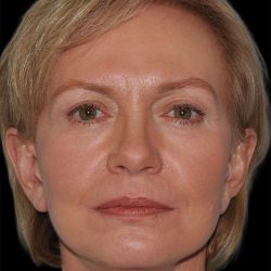 Facelift Before & After Patient #9131