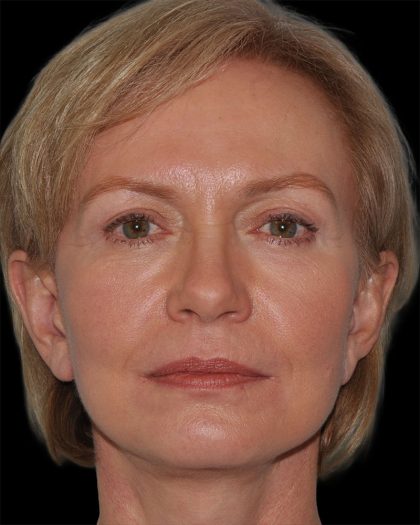 Facelift Before & After Patient #9131