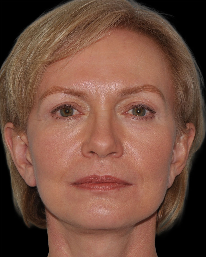 Facelift Before & After Patient #9131