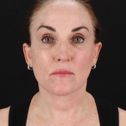 Facelift Before & After Patient #8943