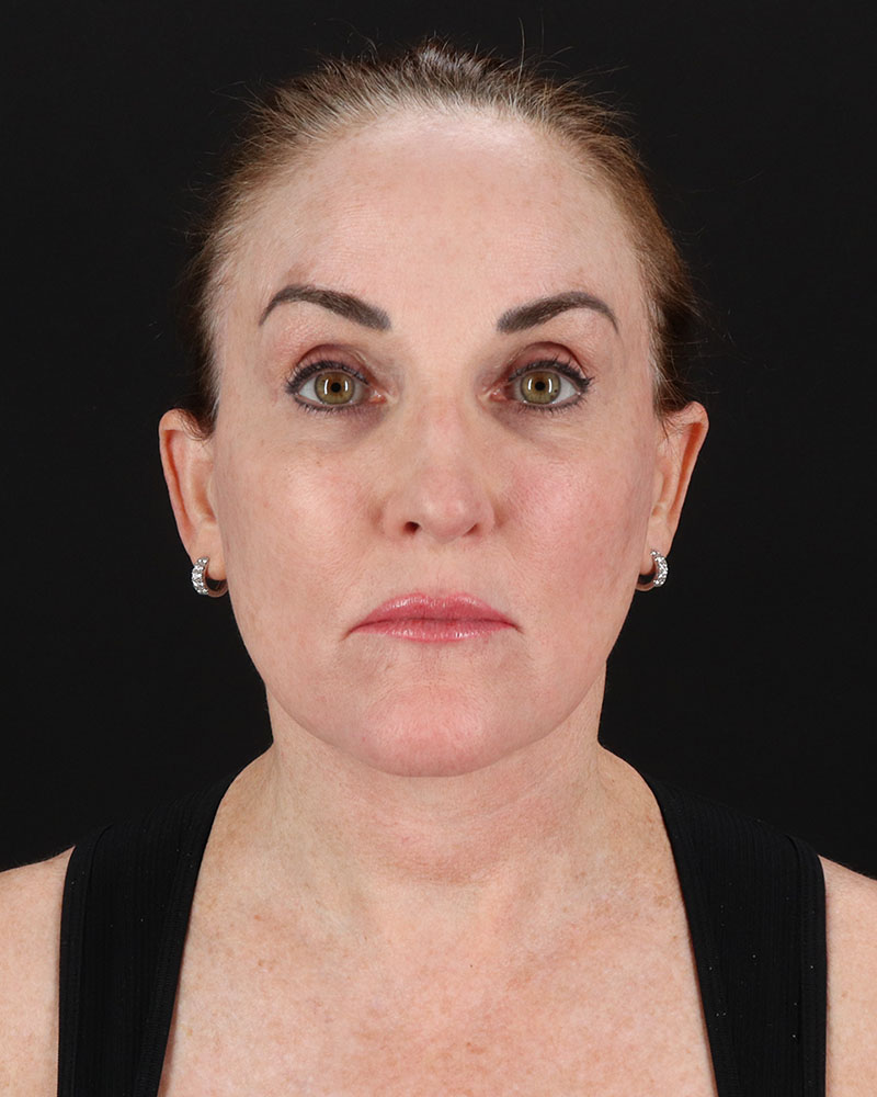 Facelift Before & After Patient #8943