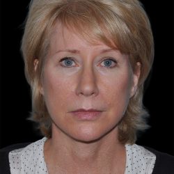 Facelift Before & After Patient #9135