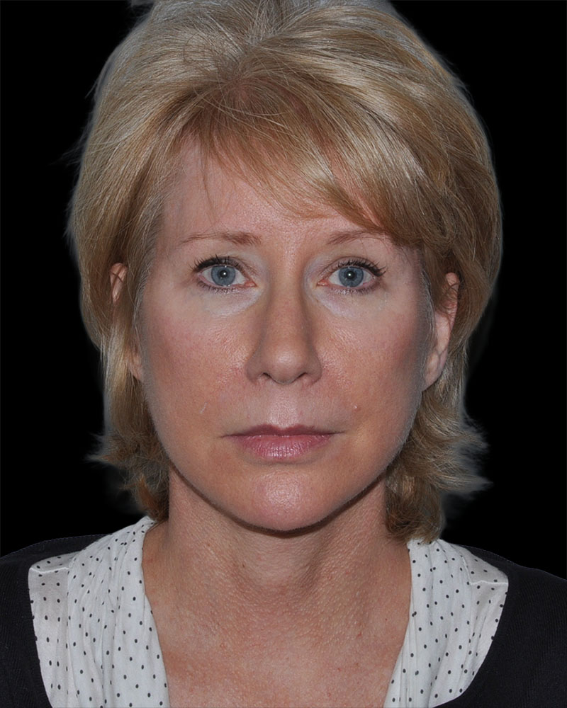 Facelift Before & After Patient #9135