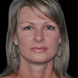 Facelift Before & After Patient #9138