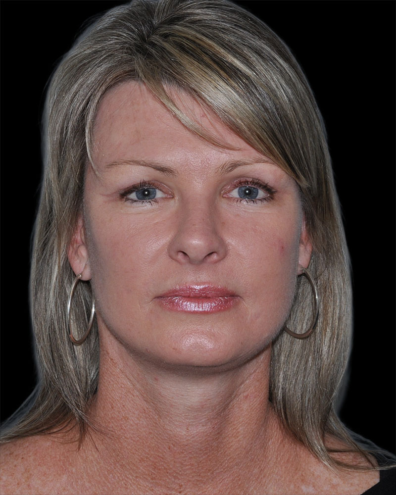 Facelift Before & After Patient #9138