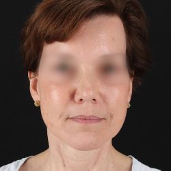 Facelift Before & After Patient #9173