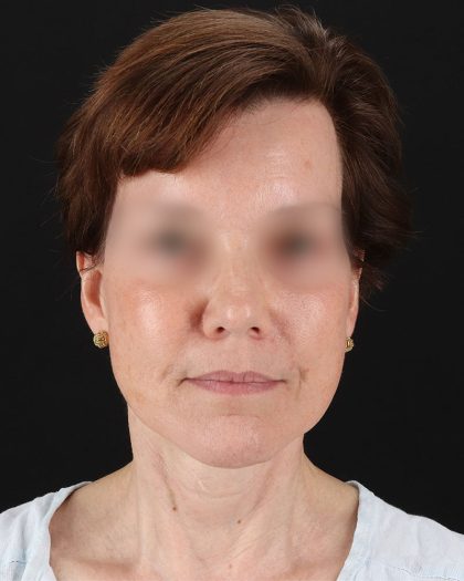 Facelift Before & After Patient #9173