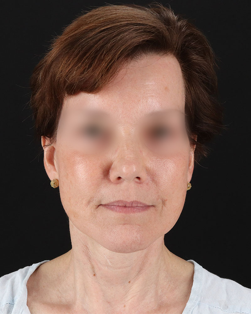 Facelift Before & After Patient #9173