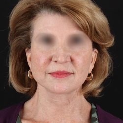 Facelift Before & After Patient #9140