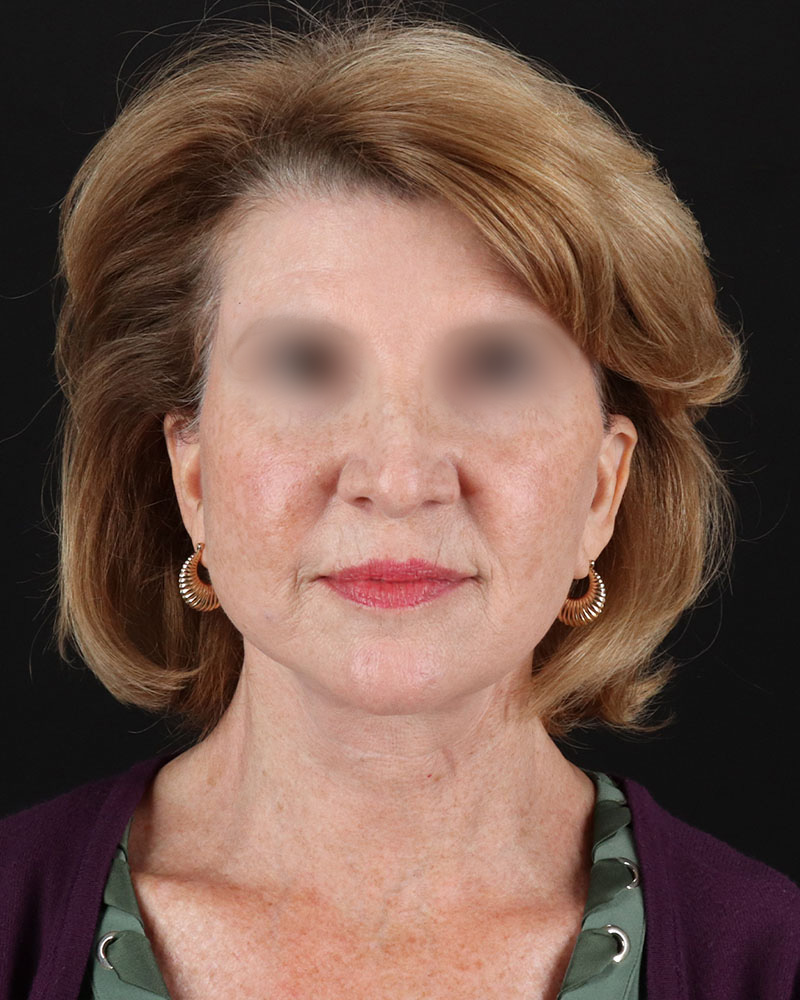 Facelift Before & After Patient #9140