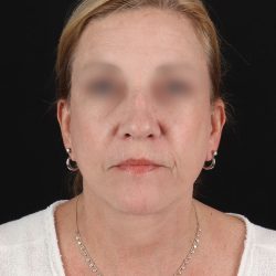 Facelift Before & After Patient #8957
