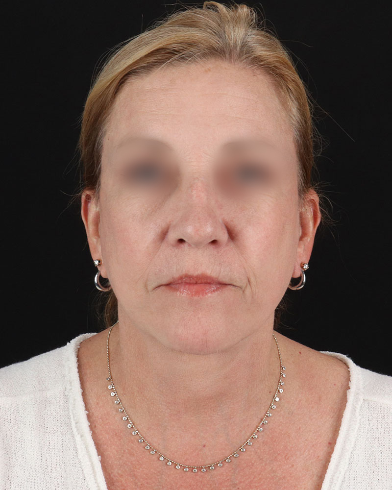 Facelift Before & After Patient #8957