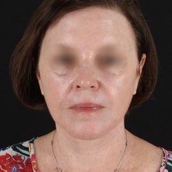 Facelift Before & After Patient #8954