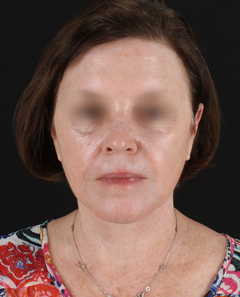 Facelift Before & After Patient #8954