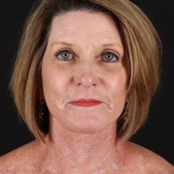 Facelift Before & After Patient #8944